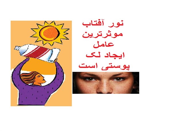 نور آفتاب موثرترین عامل درایجاد لک پوستی است