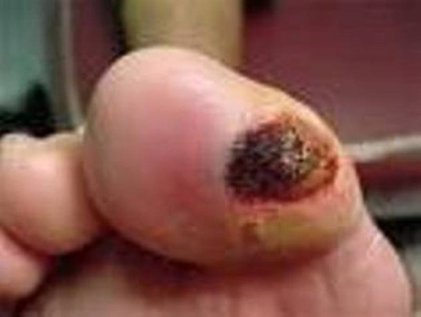 افراد دیابتی از پوشیدن کفش های نوک باریک پرهیز کنند