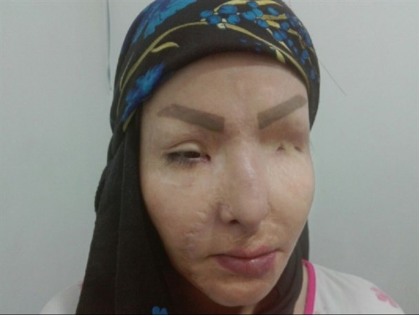 تازه ترین اظهارات دختر جوان دهدشتی که قربانی اسید پاشی شد+ تصاویر