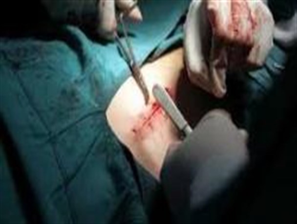 خارج کردن سوزن از معده یک زن پس از 2 سال