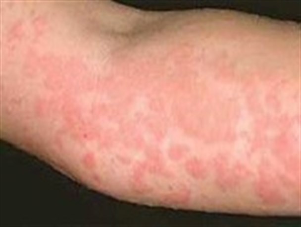 روابط جنسی آزاد عامل شیوع بیماری گال/ پیشگیری از بیماری گال با رعایت اصول اخلاقی و بهداشتی