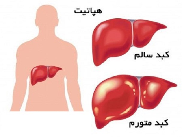 بیش از 90 هزار مشهدی از هپاتیت خود اطلاع ندارند/ زنگ خطر ابتلا به هپاتیت C در حاشیه شهر مشهد به صدا در آمده است