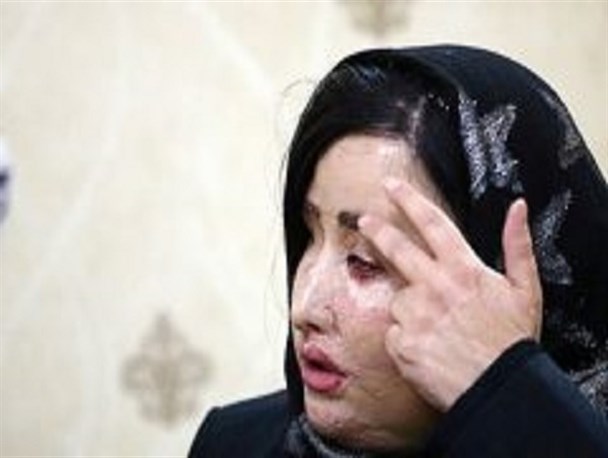 وزیر بهداشت چشم قربانی اسیدپاشی را معاینه کرد