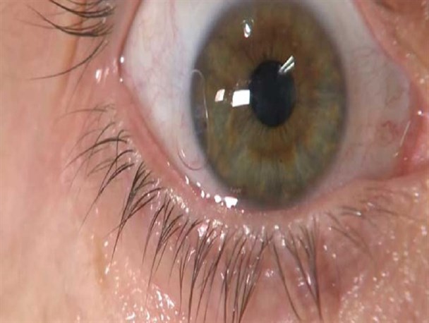 چشم‌ها می توانند تا هفته‌ها منبع انتقال ویروس کرونا باشند