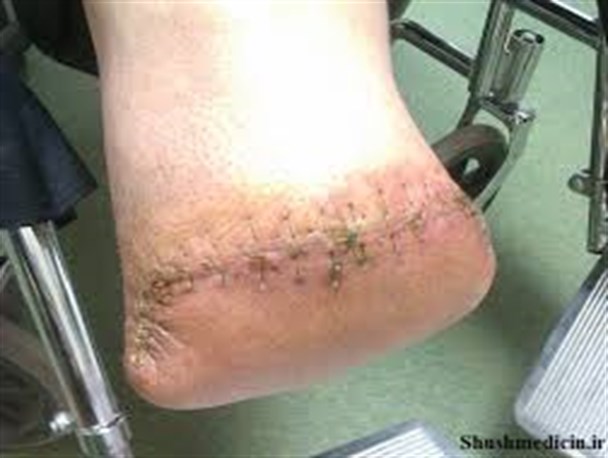 دومین عامل قطع عضو بعد از تصادفات ، دیابت است
