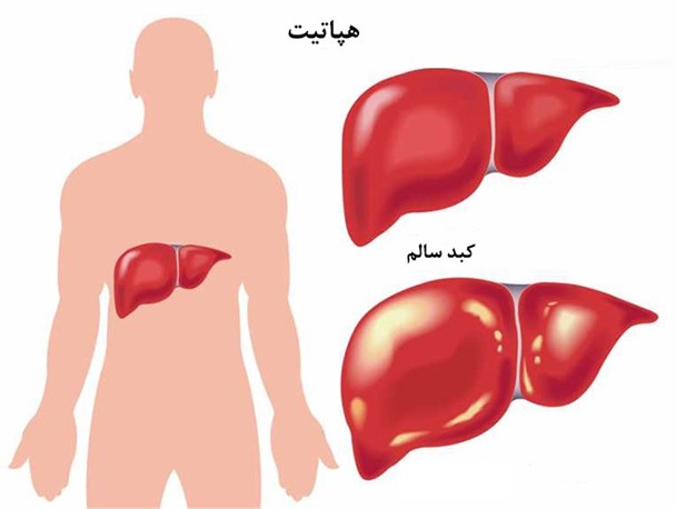 شناسایی ۱۸۵۰ مبتلا به هپاتیت B در مشهد