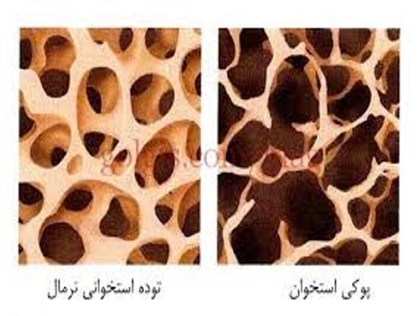 خانم ها بیشتر به بیماری پوکی استخوان مبتلا می شوند