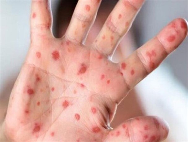 ابتلای ۹۶ نفر به سرخک در کشور/ توضیحات وزرات بهداشت در خصوص پیشگیری و مراقبت از این بیماری