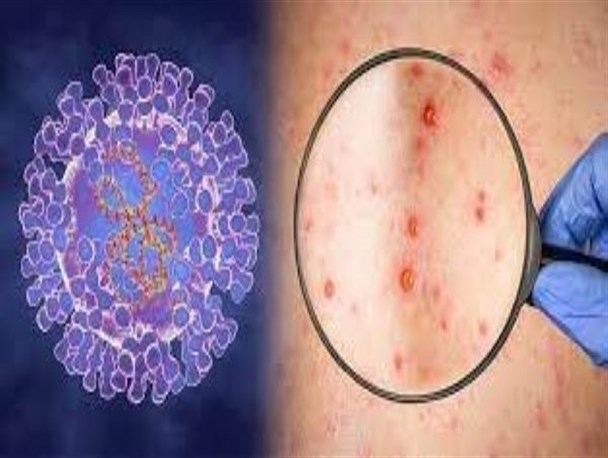 احتمال شیوع آبله میمونی دور از ذهن نیست/ تاکنون نمونه مثبتی اعلام نشد
