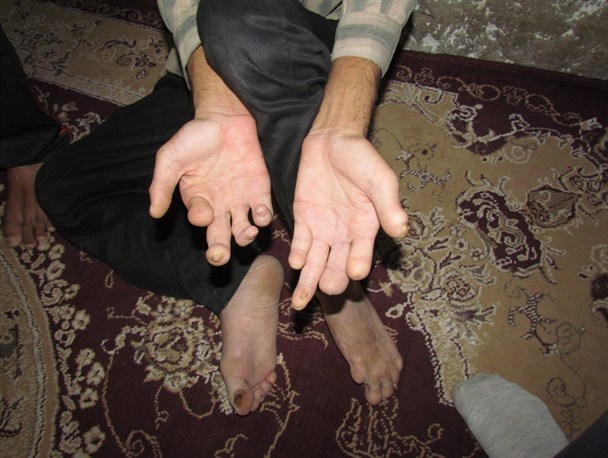 دردهای ناتمام خانواده فینی با بیماری ناشناخته / زخم هایی که با فقر و نداری وخیم تر می شوند+تصویر