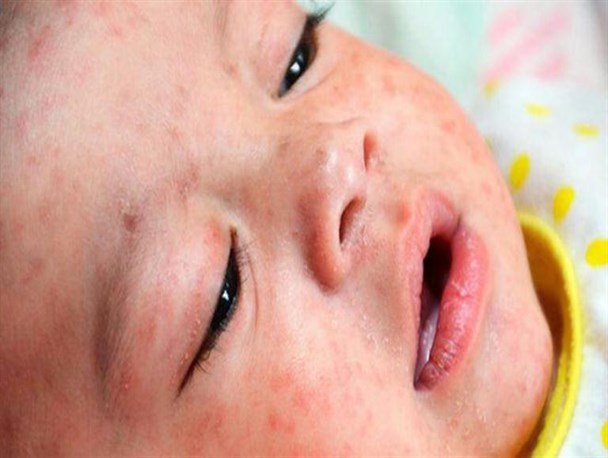 سرخک و سرخجه، تحفه اتباع بیگانه غیرمجاز برای هرمزگان