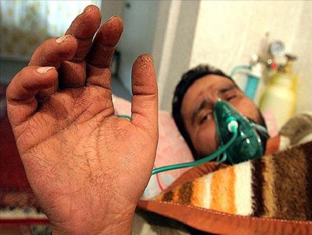 یک هزار جانباز شیمیایی سیستان و بلوچستان ،نماد حقوق بشر آمریکایی