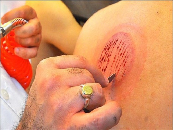 «حجامت» و حقایقی که نمی‌دانیم/ ۱۰۰ دلیل برای انجام "حجامت در فصل بهار" و تضمین سلامتی!