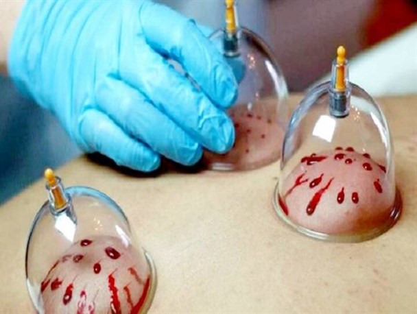 چرا حجامت‌کنندگان بیشتر عمر می‌کنند؟