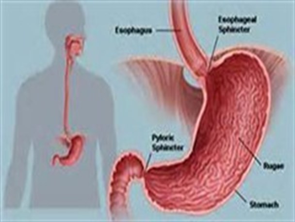 پیشگیری از زخم معده با رعایت بهداشت/ تاثیر سبک زندگی در بروز زخم معده