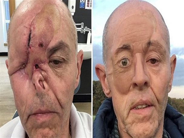 سرطان نیمی از صورت مرد انگلیسی را از بین برد+ عکس(12+)