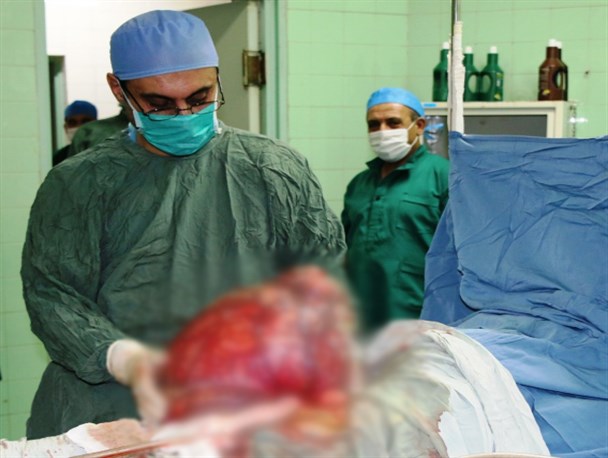 کیست 15 کیلوئی از شکم یک زن در سلماس خارج شد