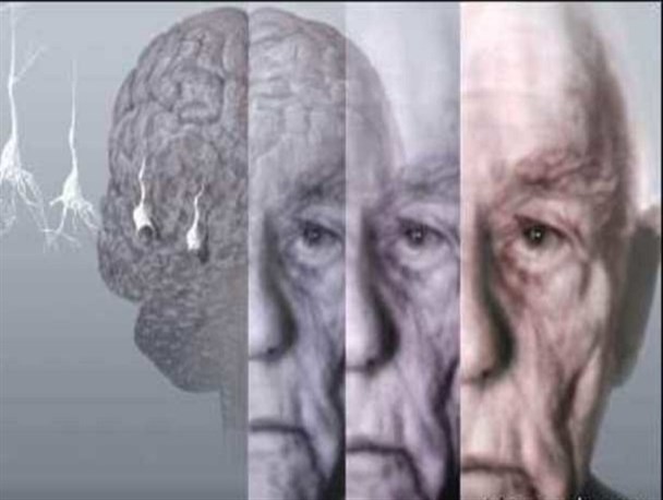آلزایمر در کمین زنان چاق+  10 علامت هشداردهنده