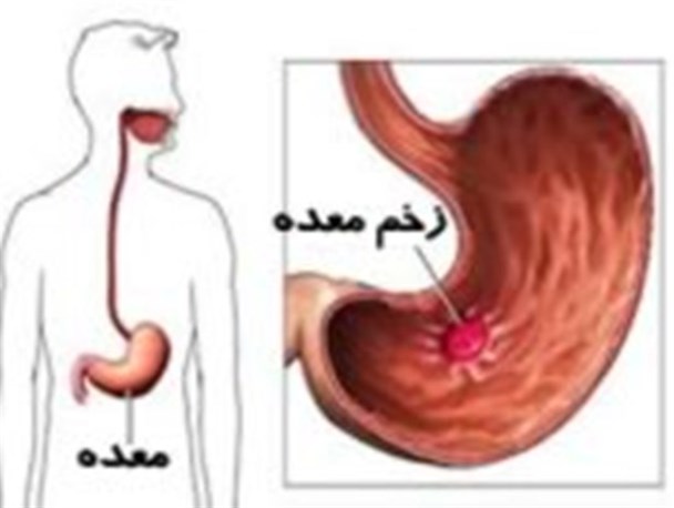 نقش وضع اقتصادی با امکان بروز سرطان معده/ لزوم آزمایش آندوسکوپی عمومی برای تشخیص زودتر بیماری