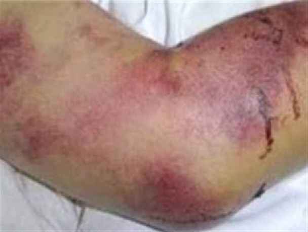 احتمال ابتلای یک مازندرانی به تب کریمه کنگو