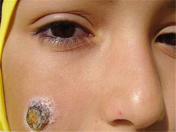 ابتلای سالانه ۲۲ هزار نفر به سالک در کشور/ ضرورت توجه به مقاومت حشرات ناقل به سموم