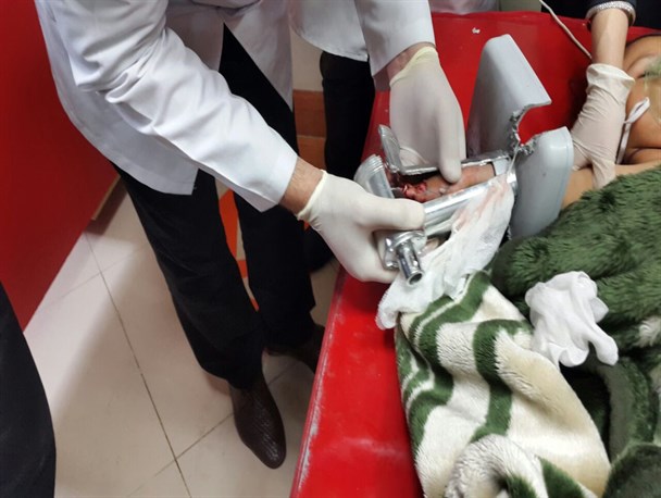 چرخ گوشت دست دختر بچه 18 ماهه مریوانی را بلعید