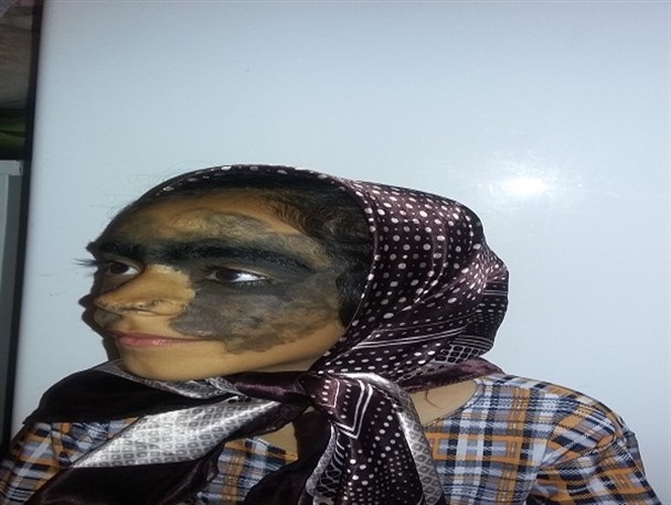 قصه تلخ دختر هفت ساله عنبرآبادی با بیماری نادر پوستی