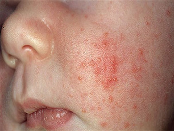 هشدار وزارت بهداشت درباره شیوع سرخک در کشور/ فراخوان واکسیناسیون کودکان ایرانی و مهاجر زیر ۵ سال+عکس