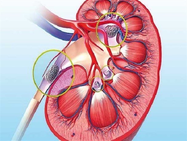 عادات غلط زندگی، یکی از علل بی اختیاری ادرار/ از خود درمانی بپرهیزید