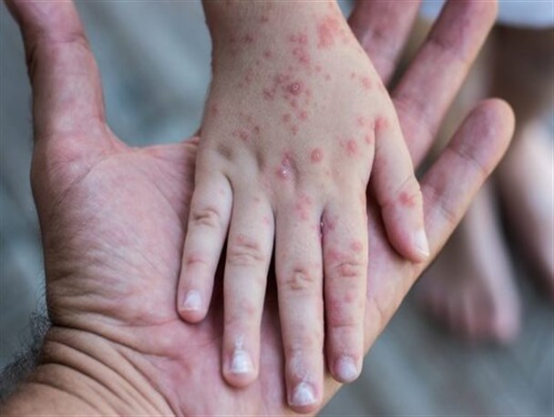 سرخک با علائم سرماخوردگی ساده شروع می‌شود/ والدین نسبت به تزریق واکسن کودکان اقدام کنند