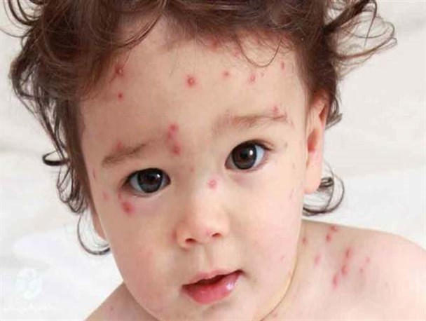 پوشش واکسن سرخک در استان زنجان ۱۰۰ درصد است/ موردی از بیماری سرخک در استان نداشتیم