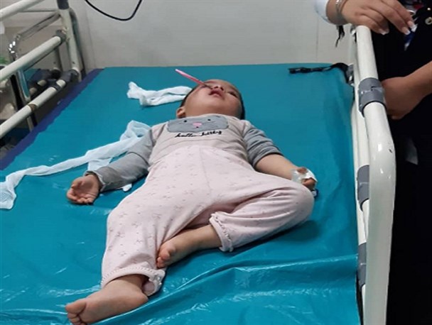 قیچی فرورفته در صورت دختر بچه آبیکی خارج شد