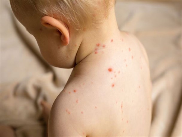 وقتی تائیدیه و تکذیبیه درباره یک بیماری، شهروندان البرز را نگران کرد/ سرخک بیماری حاد عفونی که بلای جان کودکان است