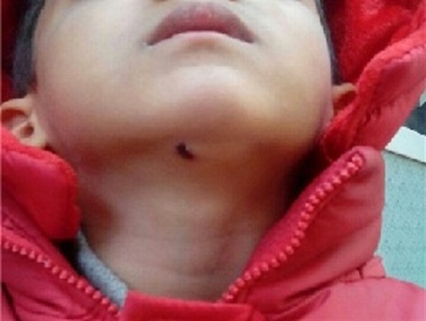 سیاه نمایی از جامعه ایرانی با زخم چند میلی متری چانه کودک خمینی شهری