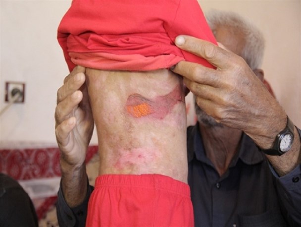 جزئیات بیشتر از بیماری نادر کودکان جنوب کرمان/تصاویر 18+