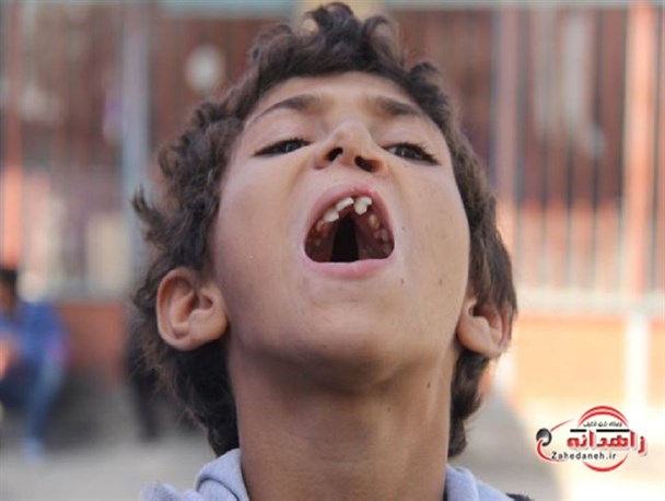 زندگی با نادرترین بیماری/ تنها آرزویم حرف زدن مانند هم سن و سالانم است