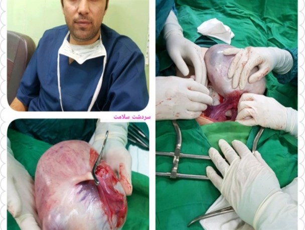 توده ۵ کیلویی از شکم بیمار ۲۰ ساله سردشتی با موفقیت خارج شد