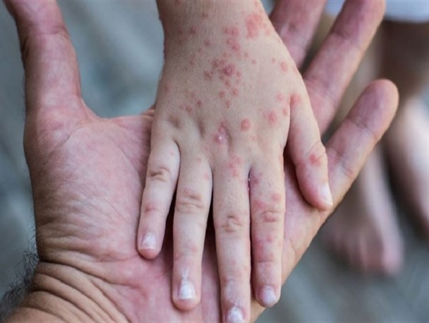 خطر طغیان سرخک در استان قزوین جدی است