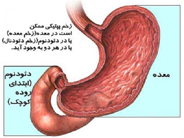 مصرف بی رویه مسکن ها موجب خونریزی دستگاه گوارش می شود