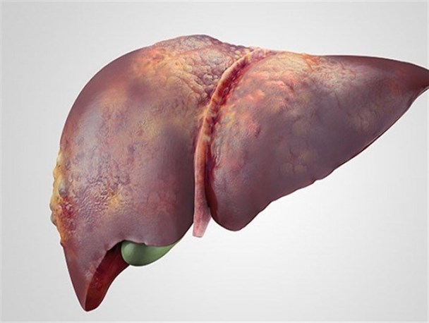 ۱۵ دستورالعمل ساده طب سنتی برای درمان "کبد چرب"