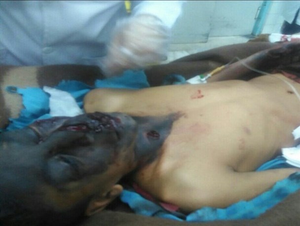 انفجار نارنجک دست ساز در زابل باعث مصدومیت نوجوان ۱۳ ساله شد+عکس
