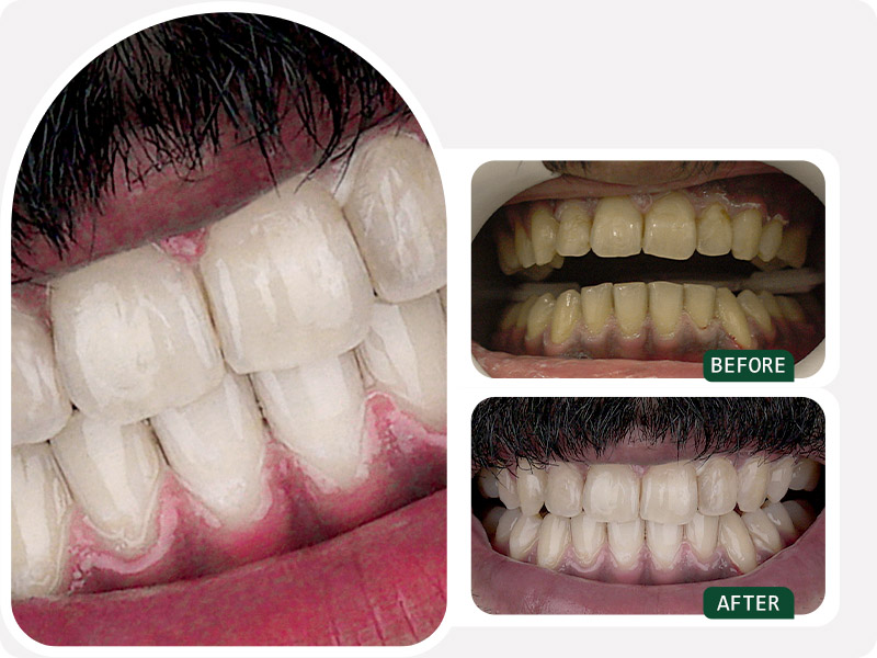 بررسی انواع بلیچینگ دندان | معرفی و مقایسه هوم و آفیس بلیچینگ