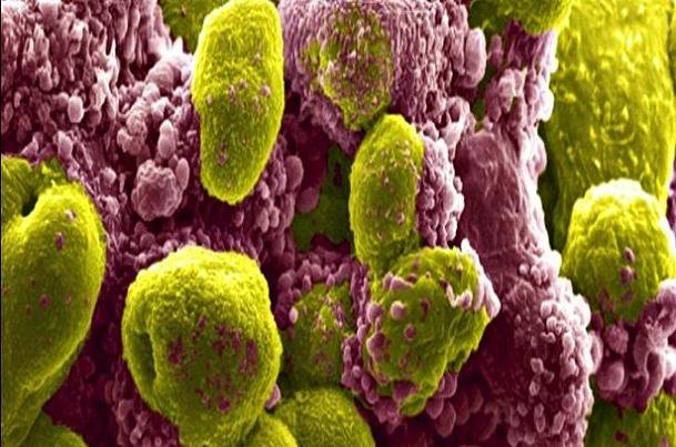 تاثیر یک ترکیب دارویی در کاهش خطر مرگ ناشی از سرطان