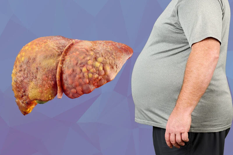 خطر پنهان کبد چرب؛ سیروز در جوانان دیابتی