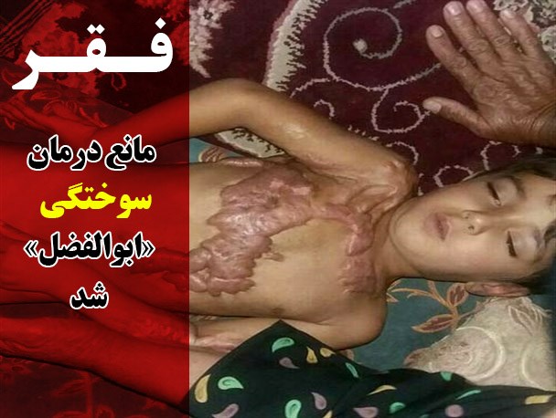 فقر مانع درمان سوختگی ابوالفضل شد + عکس