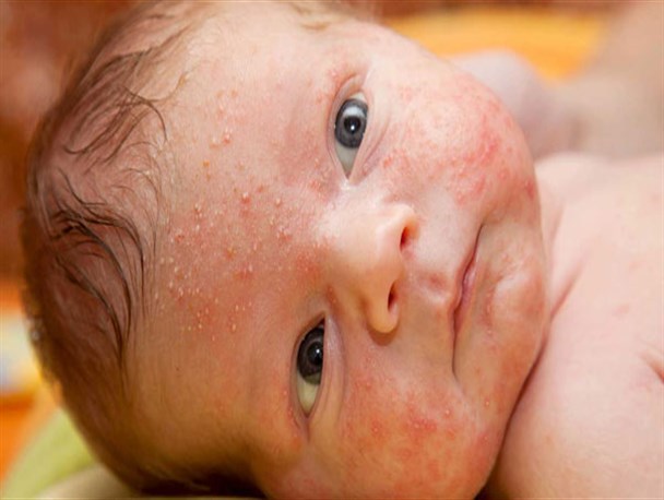 "عفونت مغزی" و "نابینایی" دو عارضه مهم بیماری سرخک/ بزرگسالانِ واکسن نزده هم در معرض ابتلا قرار دارند