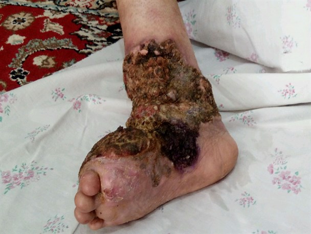 سردرگمی بیماران EB در بیمارستان ها/ سوختن و ساختن با دردی که از استخوان هم گذشته است/ پروانه ای ها رها شده اند!+تصاویر