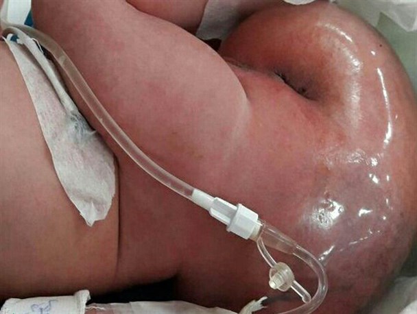 توده ۶۶۰ گرمی از کمر نوزاد یک روزه خارج شد+تصویر