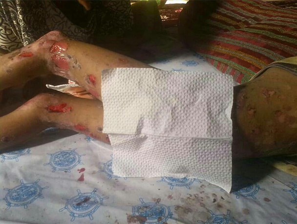 بیماری پروانه ای بلای جان کودکان سیستانی/امیر حسن در بستر نامهربانی های زندگی