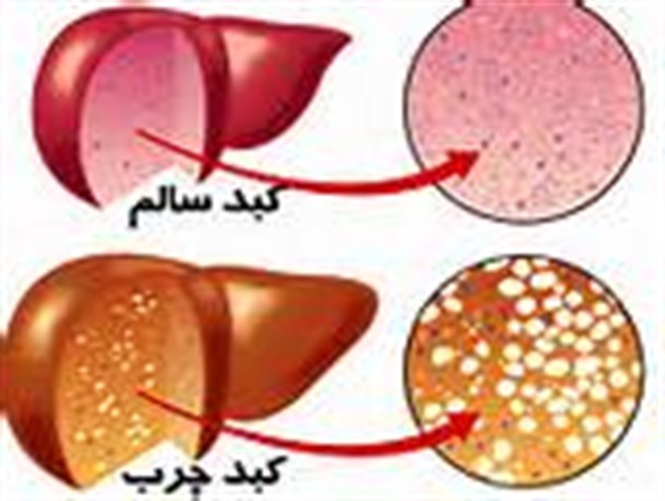 کاهش وزن ناگهانی، باعث بروز کبد چرب می شود